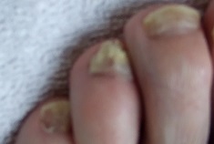 Fungal infection in toe nails